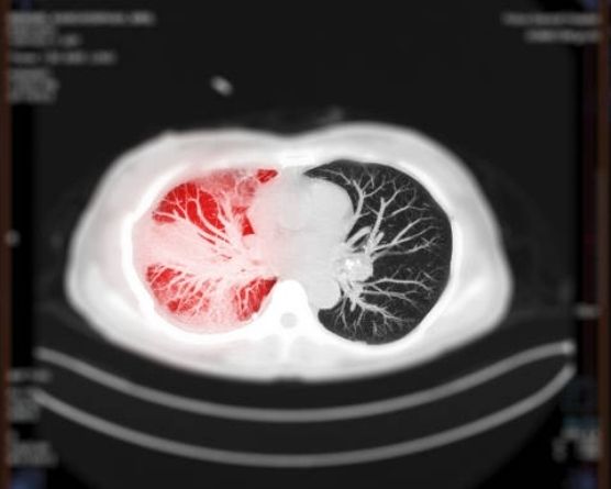 embolia pulmonar