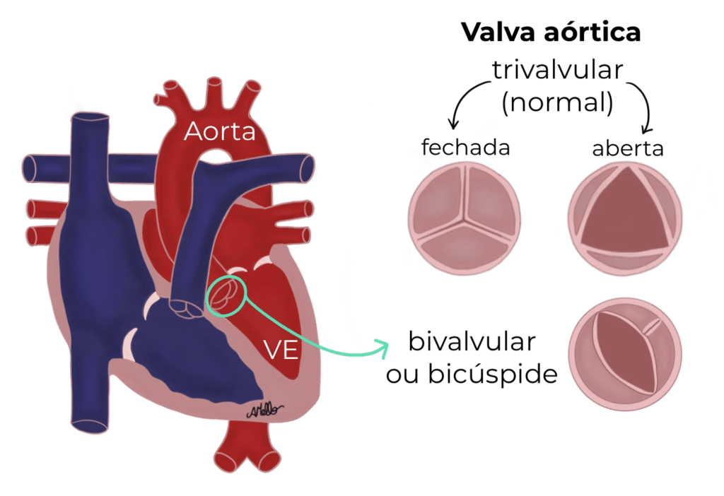 Válvula Aórtica Bicúspide