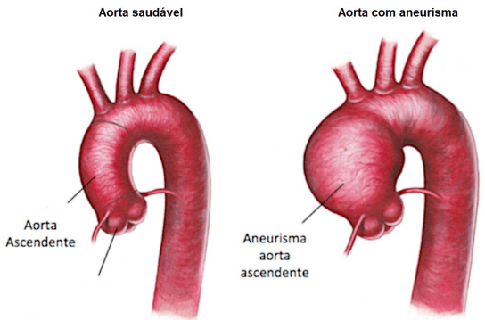 Aneurisma de Aorta Ascendente